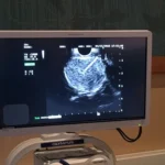 Olympus+EUS+Potato+Tumor+EZshot+needle
