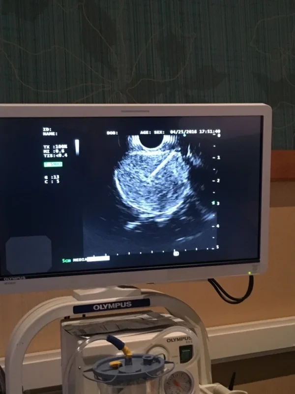 Olympus+EUS+Potato+Tumor+EZshot+needle